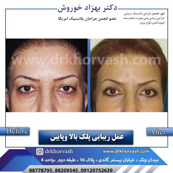 بلفاروپلاستی