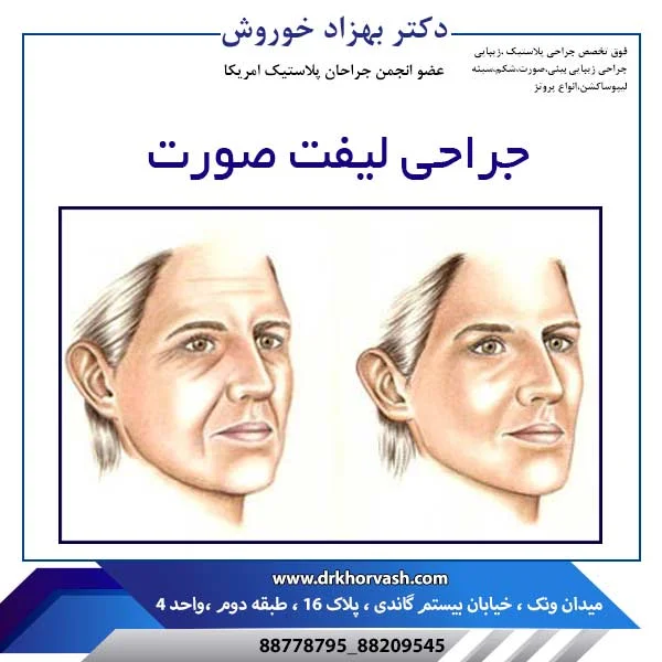 جراحی لیفت صورت _ دکتر بهزاد خوروش
