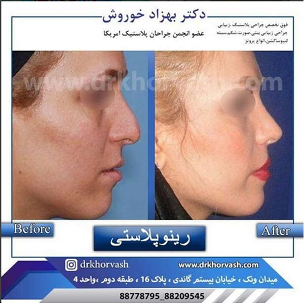 نمونه کار عمل توسط بهترین فوق تخصص پلاستیک