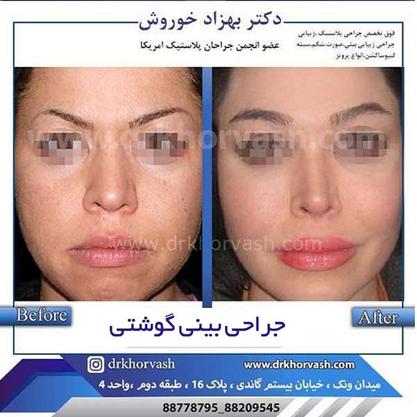 جراحی بینی گوشتی - دکتر بهزاد خوروش