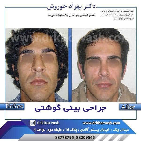 جراحی بینی گوشتی - دکتر خوروش