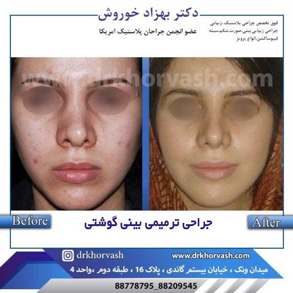 جرارحی بینی گوشتی - دکتر خوروش