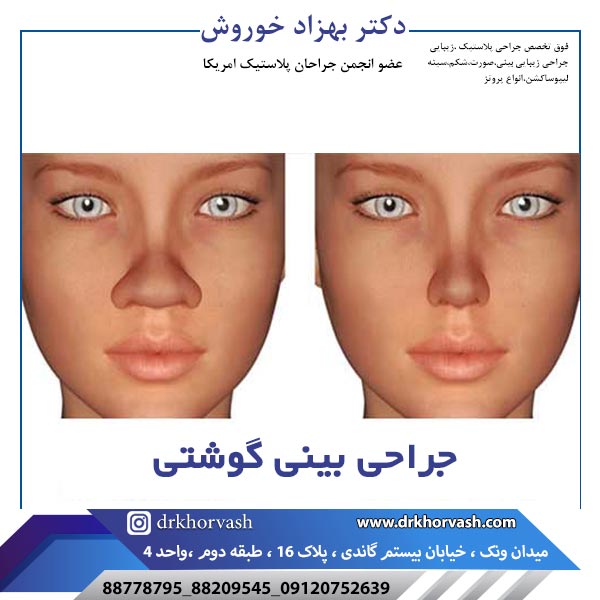 جراحی بینی گوشتی - دکتر خوروش