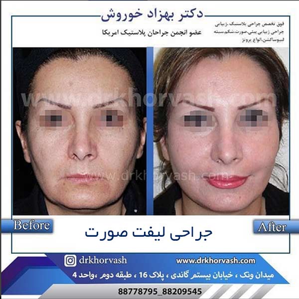 جراحی لیفت صورت _ دکتر بهزاد خوروش