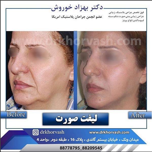 لیفت صورت درتهران - دکتر خوروش