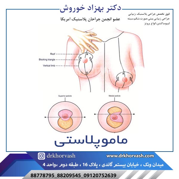 ماموپلاستی- دکتر بهزاد خوروش-drkhorvash.com