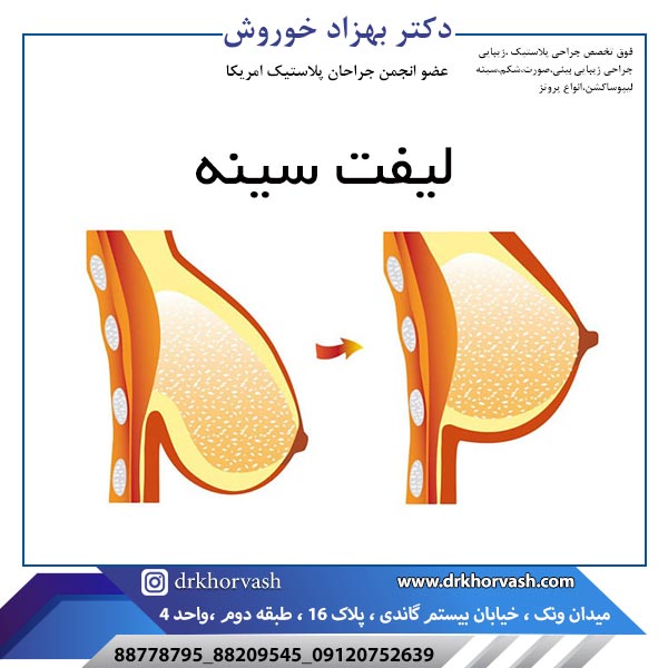 لیفت سینه - دکتر بهزاد خوروش-drkhorvash.com