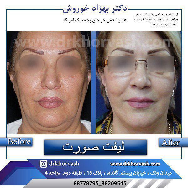 لیفت صورت - دکتر بهزاد خوروش