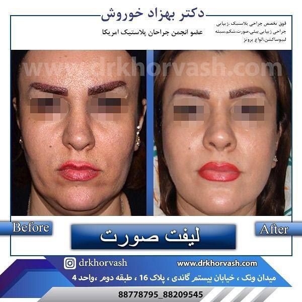 لیفت صورت - دکتر بهزاد خوروش