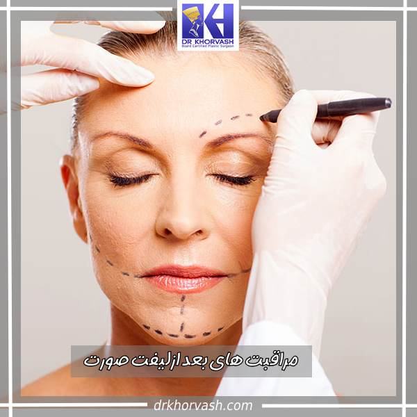 مراقبت های بعد از لیفت صورت