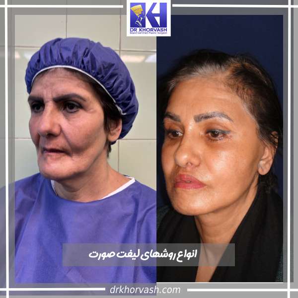 انواع روشهای لیفت صورت