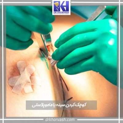 ماموپلاستی یا کوچک کردن سینه - دکتر بهزاد خوروش- drkhorvash.com
