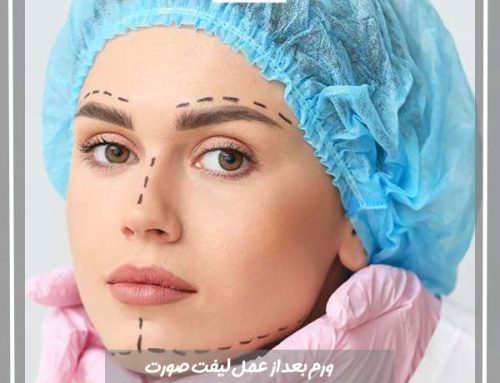 تورم بعد از عمل لیفت صورت + نحوه درمان و خطر