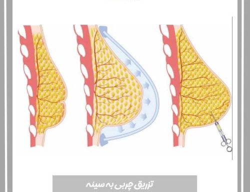 تزریق چربی به سینه + عوارض و مزایا تزریق کردن چربی