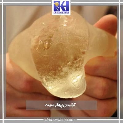 پارگی پروتز سینه- دکتر بهزاد خوروش-drkhorvash.com