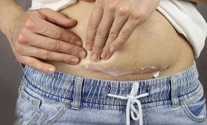 بخیه ابدومینوپلاستی _ دکتر بهزاد خوروش