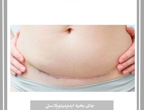 بخیه ابدومینوپلاستی و روش های رفع جای آن
