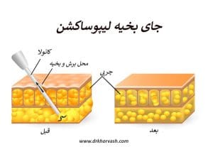 جای بخیه لیپوساکشن _ دکتر بهزاد خوروش