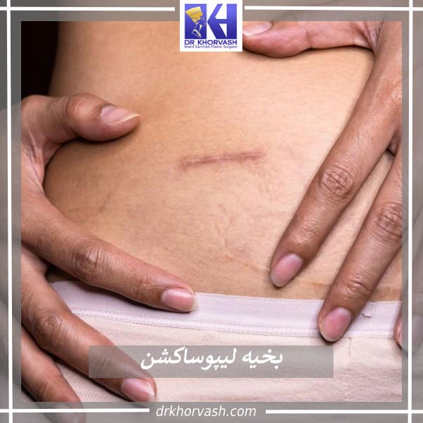 رفع جای بخیه لیپوساکشن _ دکتر بهزاد خوروش
