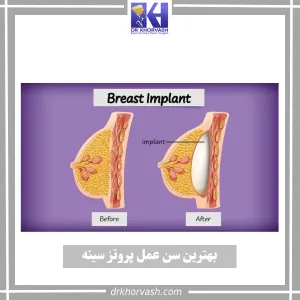 بهترین سن عمل پروتز سینه _ دکتر بهزاد خوروش