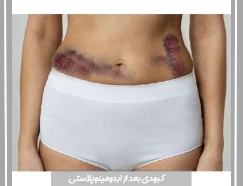 کبودی بعد از ابدومینوپلاستی | علت ، پیشگیر و درمان