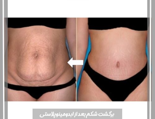 برگشت شکم بعد از ابدومینوپلاستی
