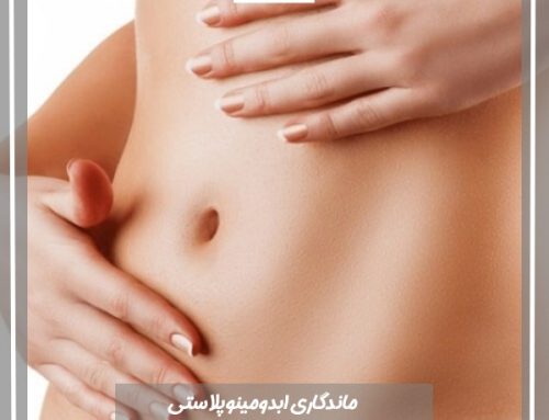 ماندگاری ابدومینوپلاستی چقدر است؟