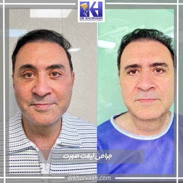 جراحی لیفت صورت