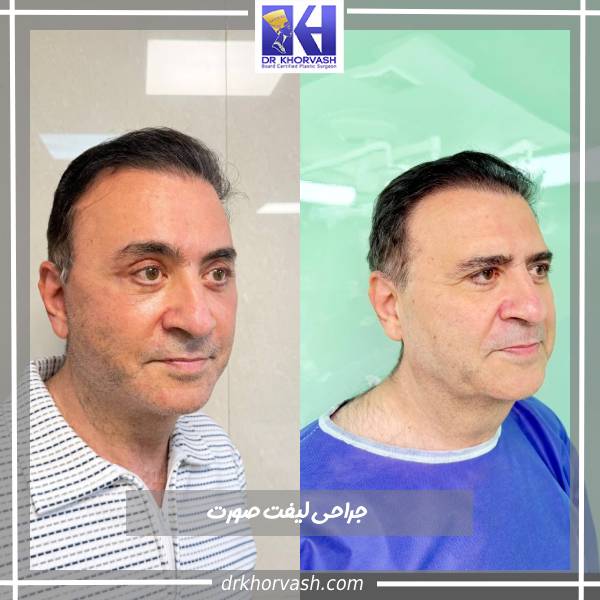 جراحی لیفت صورت