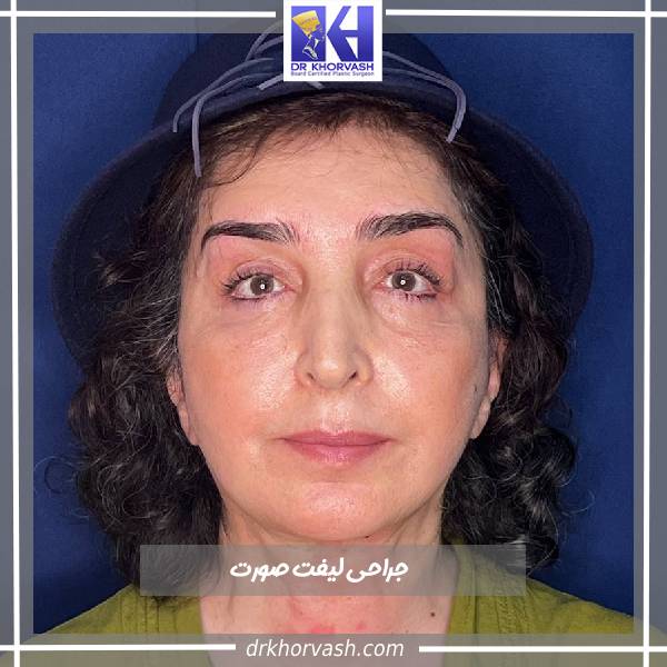 عکس قبل و بعد از لیفت صورت