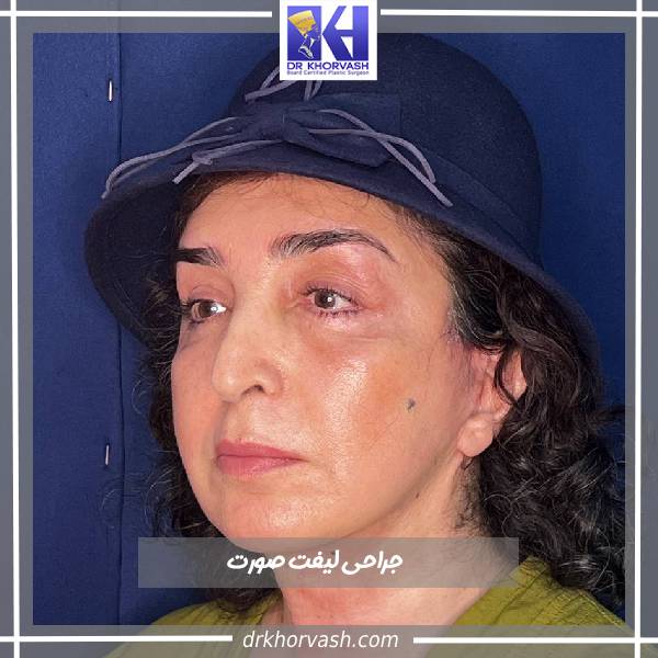 قبل و بعد از لیفت صورت
