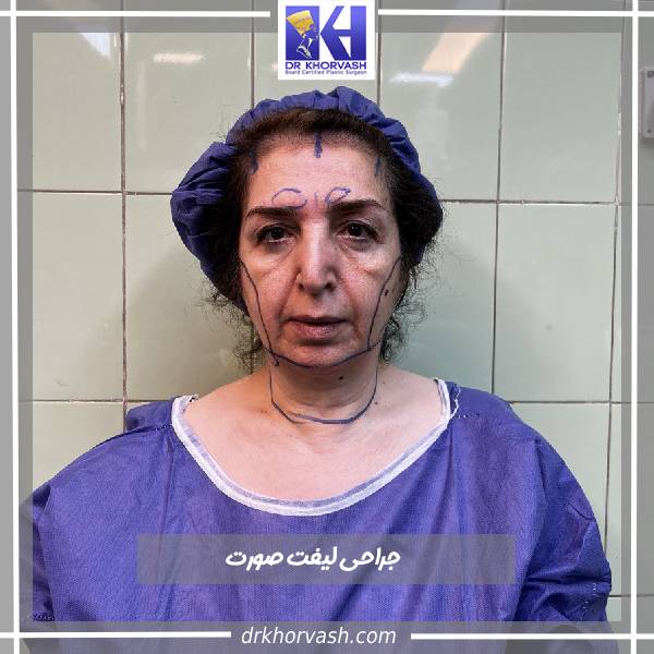عکی قبل و بعد از لیفت صورت