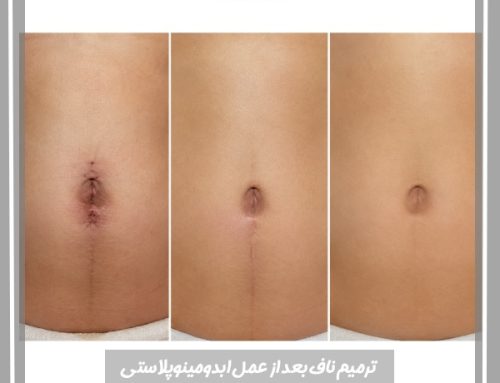 ترمیم ناف بعد از عمل ابدومینوپلاستی
